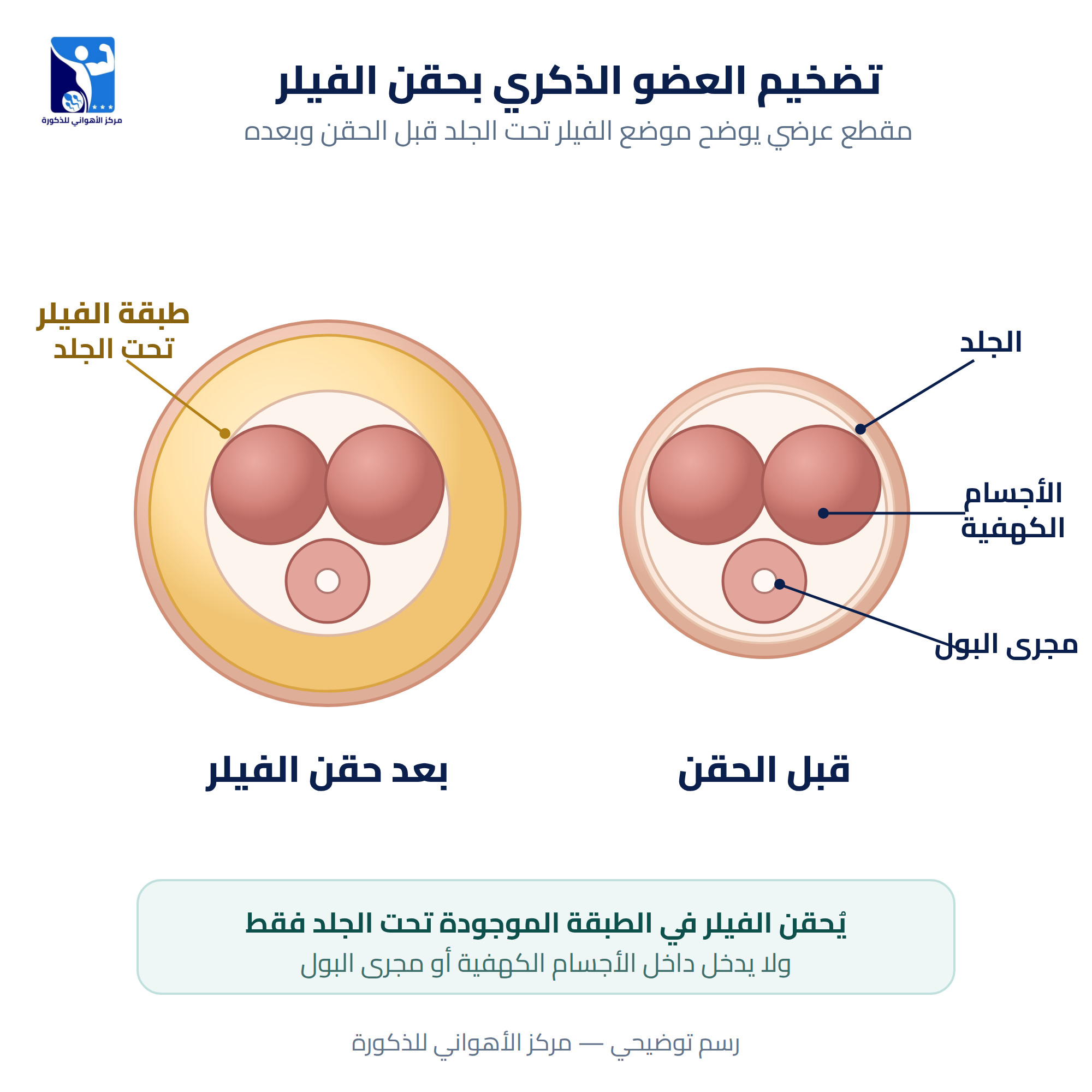 تضخيم العضو الذكري بحقن الفيلر: مقطع عرضي يوضح موضع الفيلر تحت الجلد