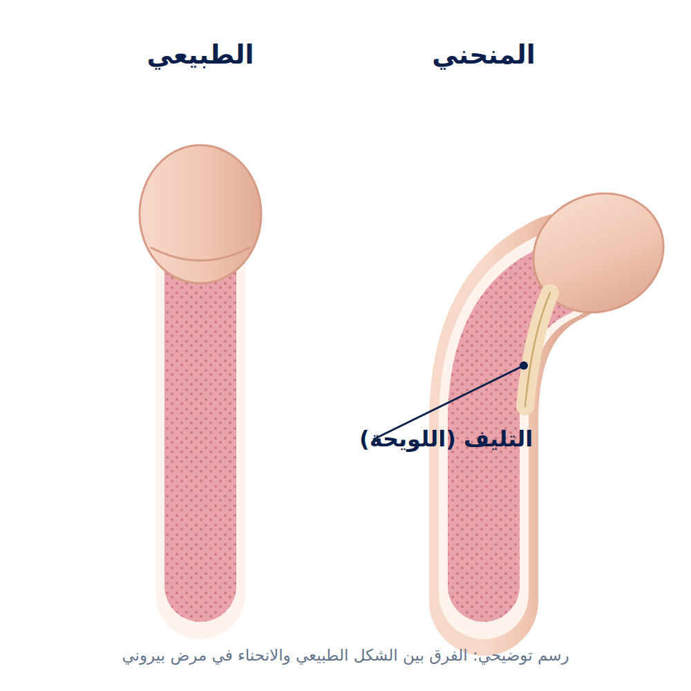 علاج مرض بيروني: اللويحة الليفية داخل الغلالة البيضاء