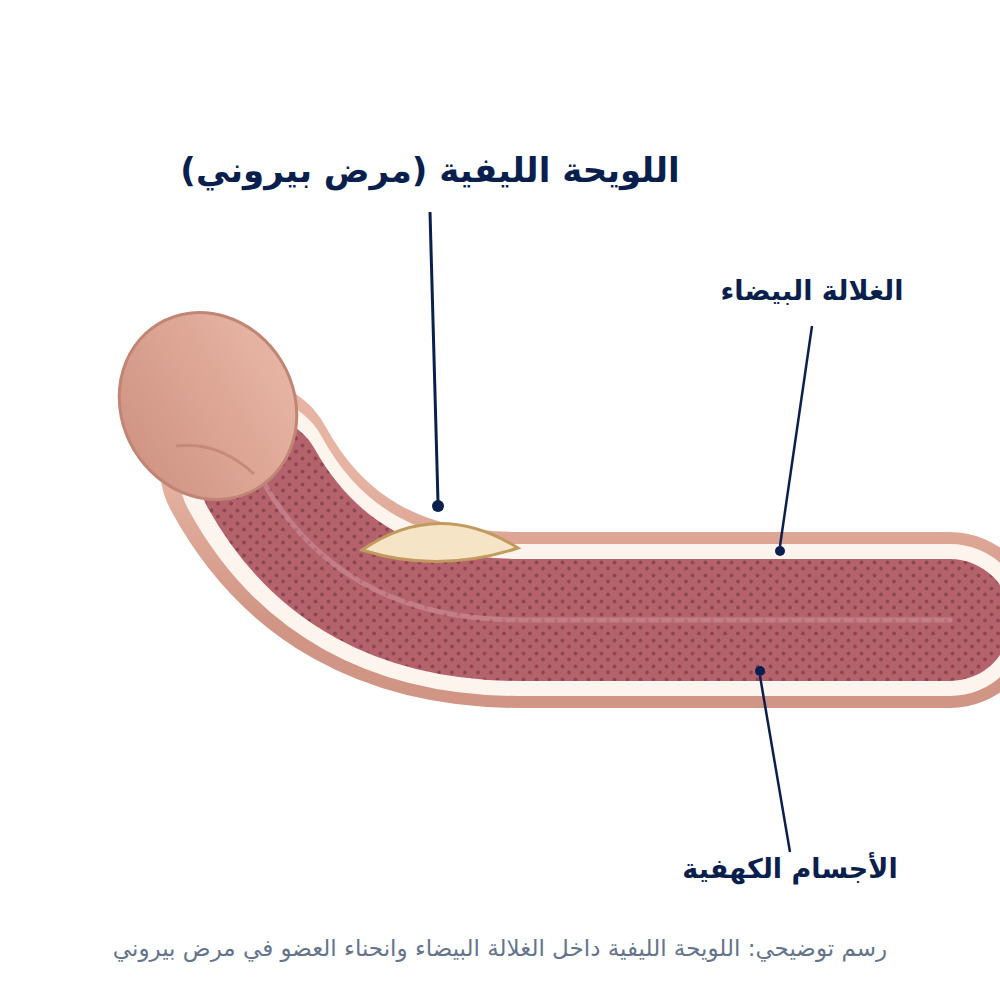 مرض بيروني بالصور: الفرق بين الشكل الطبيعي وانحناء القضيب