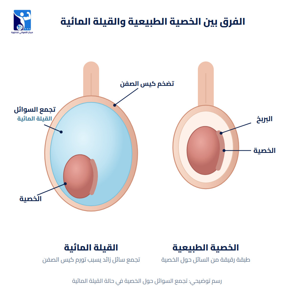 الفرق بين الخصية الطبيعية والقيلة المائية: تجمع السائل حول الخصية